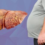 क्या आपकी लाइफस्टाइल बना रही है आपको फैटी लिवर का शिकार? युवाओं में दिख रहे ये खतरनाक संकेत